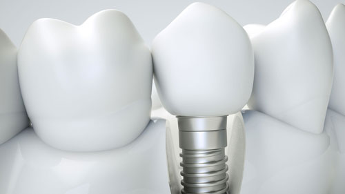 Prothèse sur implant